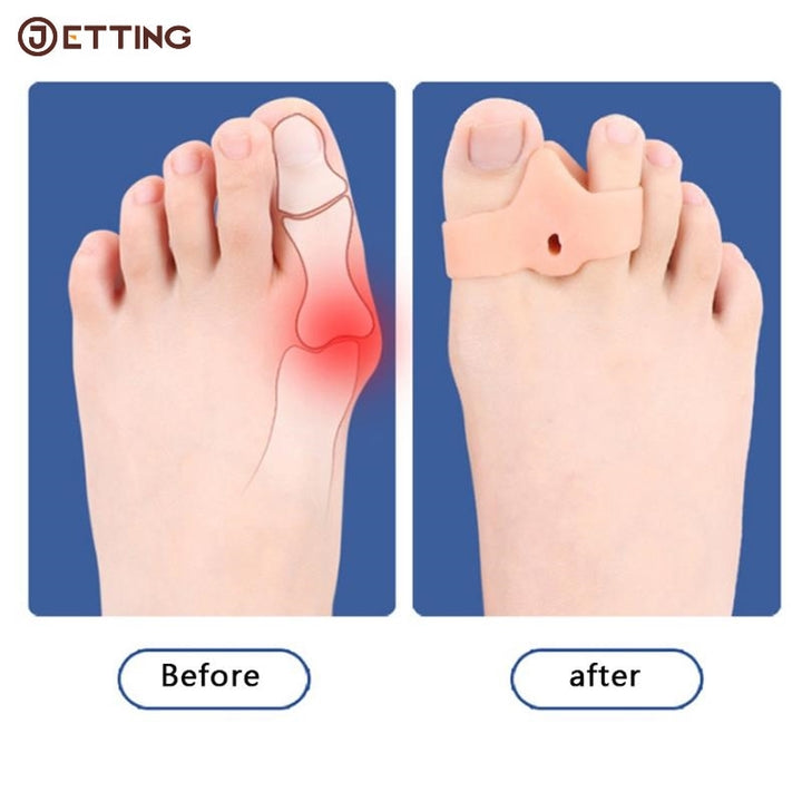 Premium Silicone Gel Bunion Corrector Toe Protector - 2PCS Orthotic Big Toe Separator & Valgus Adjuster for Foot Pain 